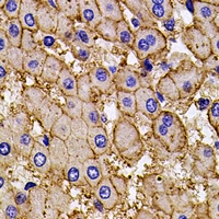 AP2A2 Antibody - Immunohistochemical analysis of AP2-alpha-2 staining in human liver cancer formalin fixed paraffin embedded tissue section. The section was pre-treated using heat mediated antigen retrieval with sodium citrate buffer (pH 6.0). The section was then incubated with the antibody at room temperature and detected using an HRP conjugated compact polymer system. DAB was used as the chromogen. The section was then counterstained with hematoxylin and mounted with DPX.