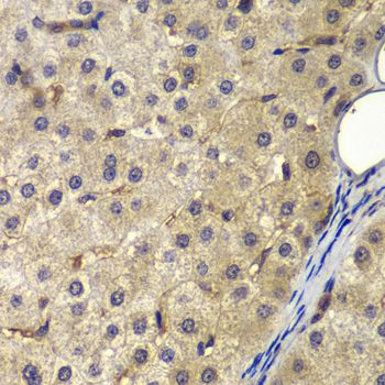 AP2A2 Antibody - Immunohistochemistry of paraffin-embedded human liver cancer using AP2A2 antibody at dilution of 1:200 (40x lens).
