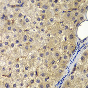 AP2A2 Antibody - Immunohistochemistry of paraffin-embedded Human liver cancer using AP2A2 Polyclonal Antibody at dilution of 1:200 (40x lens).