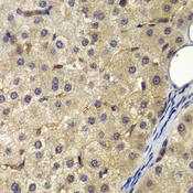 AP2A2 Antibody - Immunohistochemistry of paraffin-embedded Human liver cancer using AP2A2 Polyclonal Antibody at dilution of 1:200 (40x lens).