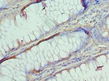 AP2B1 Antibody - Immunohistochemistry of paraffin-embedded human colon cancer using antibody at 1:100 dilution.