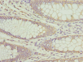 AP3B1 Antibody - Immunohistochemistry of paraffin-embedded human colon cancer at dilution 1:100