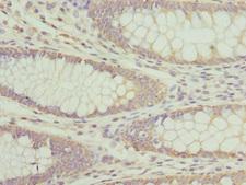 AP3B1 Antibody - Immunohistochemistry of paraffin-embedded human colon cancer at dilution 1:100
