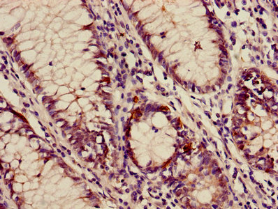 AP3M2 Antibody - Immunohistochemistry of paraffin-embedded human colon cancer using AP3M2 Antibody at dilution of 1:100