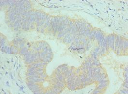 AP50 / AP2M1 Antibody - Immunohistochemistry of paraffin-embedded human colon cancer using antibody at 1:100 dilution.