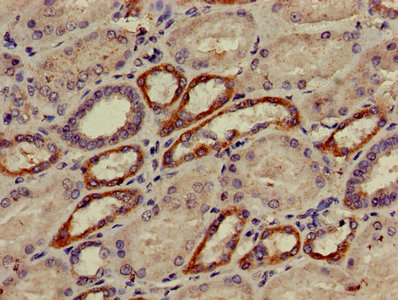 AP50 / AP2M1 Antibody - Immunohistochemistry of paraffin-embedded human cervical cancer using AP2M1 Antibody at dilution of 1:100