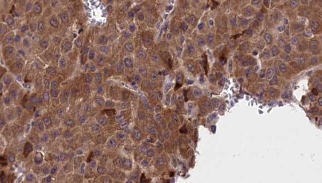 AP50 / AP2M1 Antibody - 1:100 staining human liver carcinoma tissues by IHC-P. The sample was formaldehyde fixed and a heat mediated antigen retrieval step in citrate buffer was performed. The sample was then blocked and incubated with the antibody for 1.5 hours at 22°C. An HRP conjugated goat anti-rabbit antibody was used as the secondary.