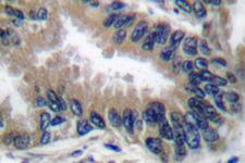 APAF1 / APAF-1 Antibody - IHC of APAF-1-ALT (H324) pAb in paraffin-embedded human lung carcinoma tissue.