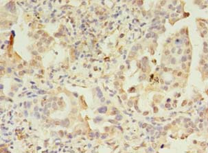 APAF1 / APAF-1 Antibody - Immunohistochemistry of paraffin-embedded human lung cancer tissue using antibody at 1:100 dilution.