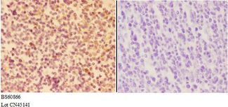APAF1 / APAF-1 Antibody - Immunohistochemistry (IHC) analysis of APAF1 antibody in paraffin-embedded human tonsil carcinoma tissue at 1:50, showing cytoplasm staining. Negative control (the right) using PBS instead of primary antibody. Secondary antibody is Goat Anti-Rabbit IgG-biotin.