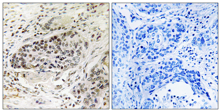 APBA2 Antibody - Immunohistochemistry analysis of paraffin-embedded human lung carcinoma tissue, using APBA2 Antibody. The picture on the right is blocked with the synthesized peptide.