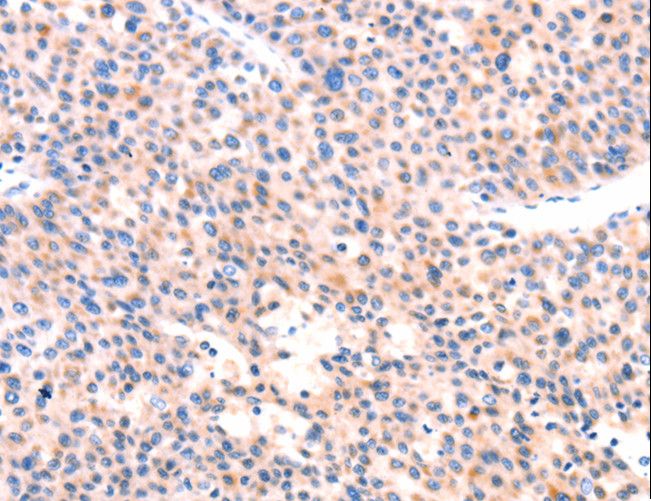 APBA2 Antibody - Immunohistochemistry of paraffin-embedded Human thyroid cancer using APBA2 Polyclonal Antibody at dilution of 1:80.