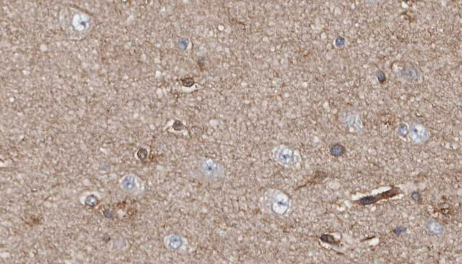APBA2 Antibody - 1:100 staining human brain carcinoma tissue by IHC-P. The sample was formaldehyde fixed and a heat mediated antigen retrieval step in citrate buffer was performed. The sample was then blocked and incubated with the antibody for 1.5 hours at 22°C. An HRP conjugated goat anti-rabbit antibody was used as the secondary.