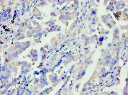 APBB1 / FE65 Antibody - Immunohistochemistry of paraffin-embedded human lung cancer using antibody at 1:100 dilution.