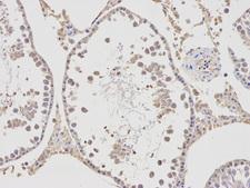 APBB1 / FE65 Antibody - Immunohistochemistry of paraffin-embedded human lung cancer using APBB1 antibody at dilution of 1:100 (200x lens).
