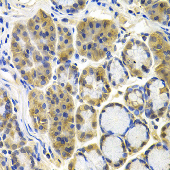 APBB1 / FE65 Antibody - Immunohistochemistry of paraffin-embedded human colon carcinoma tissue.