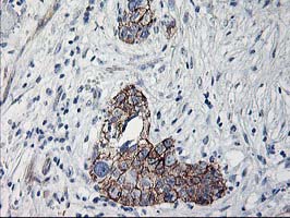 APBB3 Antibody - IHC of paraffin-embedded Adenocarcinoma of Human breast tissue using anti-APBB3 mouse monoclonal antibody.