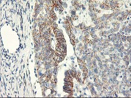 APBB3 Antibody - IHC of paraffin-embedded Adenocarcinoma of Human ovary tissue using anti-APBB3 mouse monoclonal antibody.
