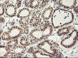 APBB3 Antibody - IHC of paraffin-embedded Carcinoma of Human thyroid tissue using anti-APBB3 mouse monoclonal antibody.