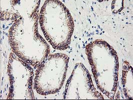 APBB3 Antibody - IHC of paraffin-embedded Carcinoma of Human prostate tissue using anti-APBB3 mouse monoclonal antibody.