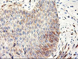APBB3 Antibody - IHC of paraffin-embedded Carcinoma of Human bladder tissue using anti-APBB3 mouse monoclonal antibody.