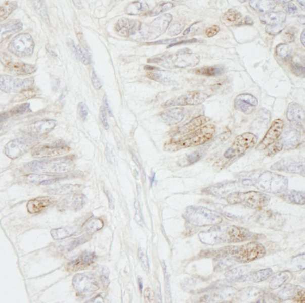 APC Antibody - Detection of Human APC by Immunohistochemistry. Sample: FFPE section of human colon carcinoma. Antibody: Affinity purified rabbit anti-APC used at a dilution of 1:250.