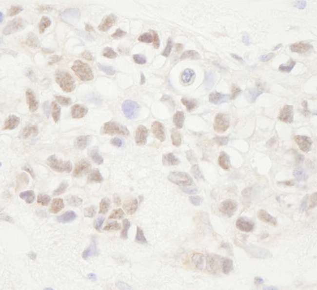 APC Antibody - Detection of Human APC by Immunohistochemistry. Sample: FFPE section of human breast carcinoma. Antibody: Affinity purified rabbit anti-APC used at a dilution of 1:1000 (1 ug/ml).