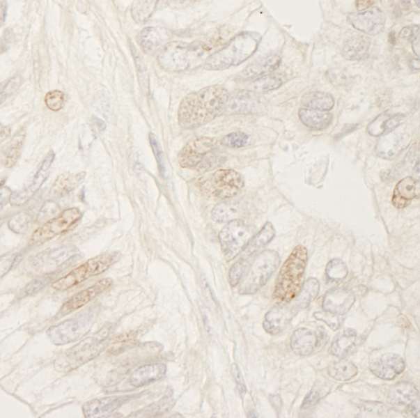 APC Antibody - Detection of Human APC by Immunohistochemistry. Sample: FFPE section of human colon carcinoma. Antibody: Affinity purified rabbit anti-APC used at a dilution of 1:1000 (1 ug/ml).
