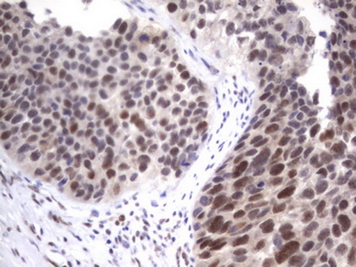 APC Antibody - IHC of paraffin-embedded Carcinoma of Human kidney tissue using anti-APC mouse monoclonal antibody. (Heat-induced epitope retrieval by 1 mM EDTA in 10mM Tris, pH8.5, 120°C for 3min).