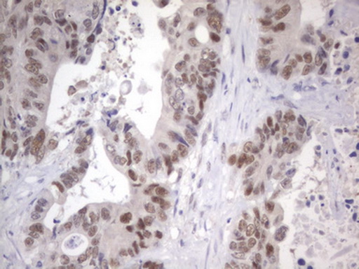APC Antibody - IHC of paraffin-embedded Adenocarcinoma of Human colon tissue using anti-APC mouse monoclonal antibody. (Heat-induced epitope retrieval by 1 mM EDTA in 10mM Tris, pH8.5, 120°C for 3min).