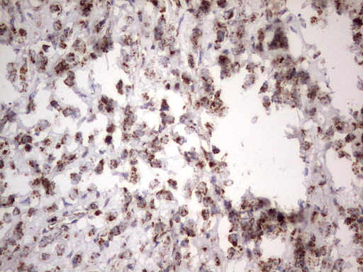 APC Antibody - IHC of paraffin-embedded Adenocarcinoma of Human breast tissue using anti-APC mouse monoclonal antibody. (heat-induced epitope retrieval by 1 mM EDTA in 10mM Tris, pH8.5, 120°C for 3min).