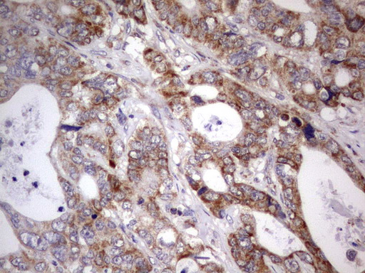 APC Antibody - IHC of paraffin-embedded Adenocarcinoma of Human colon tissue using anti-APC mouse monoclonal antibody. (heat-induced epitope retrieval by 1 mM EDTA in 10mM Tris, pH8.5, 120°C for 3min).