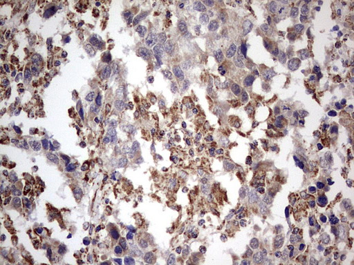 APC Antibody - IHC of paraffin-embedded Carcinoma of Human lung tissue using anti-APC mouse monoclonal antibody. (heat-induced epitope retrieval by 1 mM EDTA in 10mM Tris, pH8.5, 120°C for 3min).