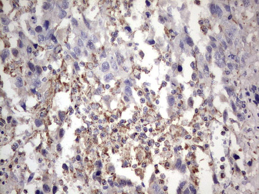 APC Antibody - IHC of paraffin-embedded Adenocarcinoma of Human ovary tissue using anti-APC mouse monoclonal antibody. (heat-induced epitope retrieval by 1 mM EDTA in 10mM Tris, pH8.5, 120°C for 3min).