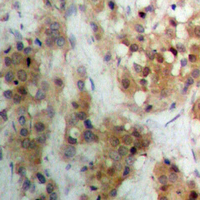 APC Antibody - Immunohistochemical analysis of APC staining in human breast cancer formalin fixed paraffin embedded tissue section. The section was pre-treated using heat mediated antigen retrieval with sodium citrate buffer (pH 6.0). The section was then incubated with the antibody at room temperature and detected using an HRP conjugated compact polymer system. DAB was used as the chromogen. The section was then counterstained with hematoxylin and mounted with DPX.