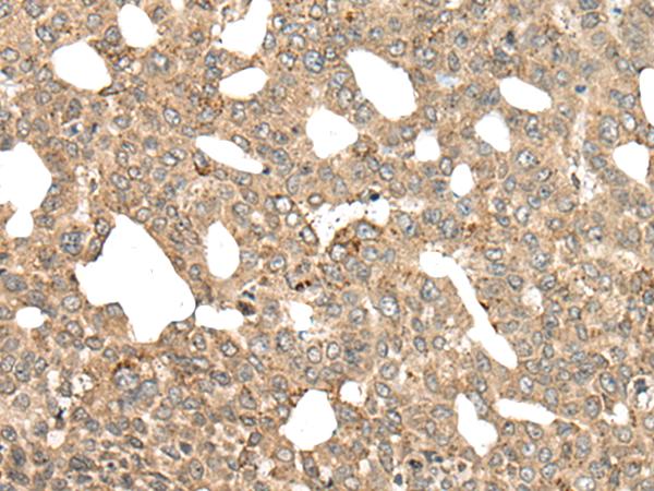 APC Antibody - Immunohistochemistry of paraffin-embedded Human liver cancer tissue  using APC Polyclonal Antibody at dilution of 1:45(×200)
