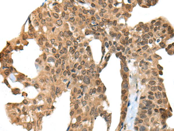 APC Antibody - Immunohistochemistry of paraffin-embedded Human thyroid cancer tissue  using APC Polyclonal Antibody at dilution of 1:45(×200)