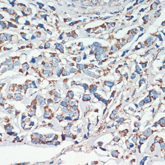 APC Antibody - Immunohistochemistry of paraffin-embedded Human breast cancer using APC Polyclonal Antibody at dilution of 1:200 (40x lens).