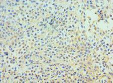 APC6 / CDC16 Antibody - Immunohistochemistry of paraffin-embedded human breast cancer using antibody at 1:100 dilution.