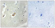 APC6 / CDC16 Antibody - Immunohistochemistry analysis of paraffin-embedded human breast carcinoma tissue, using CDC16/APC6 Antibody. The picture on the right is blocked with the synthesized peptide.