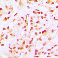 APC6 / CDC16 Antibody - Immunohistochemical analysis of CDC16 staining in human lung cancer formalin fixed paraffin embedded tissue section. The section was pre-treated using heat mediated antigen retrieval with sodium citrate buffer (pH 6.0). The section was then incubated with the antibody at room temperature and detected using an HRP conjugated compact polymer system. DAB was used as the chromogen. The section was then counterstained with hematoxylin and mounted with DPX. w