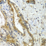 APC6 / CDC16 Antibody - Immunohistochemistry of paraffin-embedded human liver cancer tissue.