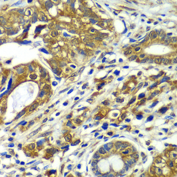 APC6 / CDC16 Antibody - Immunohistochemistry of paraffin-embedded human gastric cancer tissue.