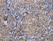 APC6 / CDC16 Antibody - Immunohistochemistry of paraffin-embedded Human thyroid cancer using CDC16 Polyclonal Antibody at dilution of 1:50.