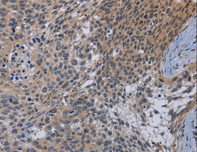 APC6 / CDC16 Antibody - Immunohistochemistry of paraffin-embedded Human cervical cancer using CDC16 Polyclonal Antibody at dilution of 1:50.