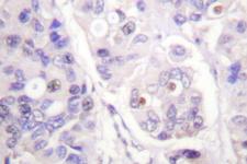 APC6 / CDC16 Antibody - IHC of Cdc16 (K556) pAb in paraffin-embedded human breast carcinoma tissue.