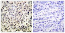 APC6 / CDC16 Antibody - Peptide - + Immunohistochemistry analysis of paraffin-embedded human breast carcinoma tissue using CDC16/APC6 (Ab-560) antibody.