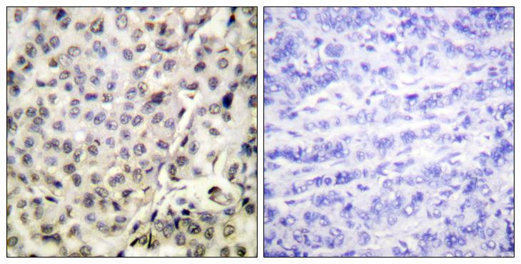 APC6 / CDC16 Antibody - Peptide - + Immunohistochemistry analysis of paraffin-embedded human breast carcinoma tissue using CDC16/APC6 (Ab-560) antibody.