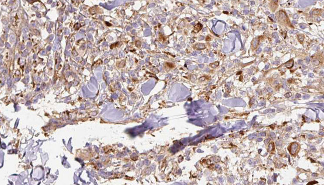 APCS / Serum Amyloid P / SAP Antibody - 1:100 staining human Melanoma tissue by IHC-P. The sample was formaldehyde fixed and a heat mediated antigen retrieval step in citrate buffer was performed. The sample was then blocked and incubated with the antibody for 1.5 hours at 22°C. An HRP conjugated goat anti-rabbit antibody was used as the secondary.