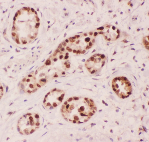 APEX1 / APE1 Antibody - APE1 antibody IHC-paraffin: Human Lung Cancer Tissue.